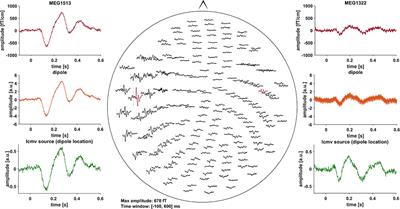 Deep Brain Stimulation Does Not Modulate Auditory-Motor Integration of Speech in Parkinson's Disease